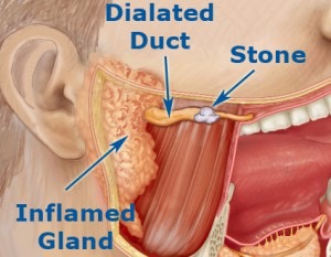 Inflamed salivary gland