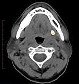 CT scan of a left submandibular gland duct stone